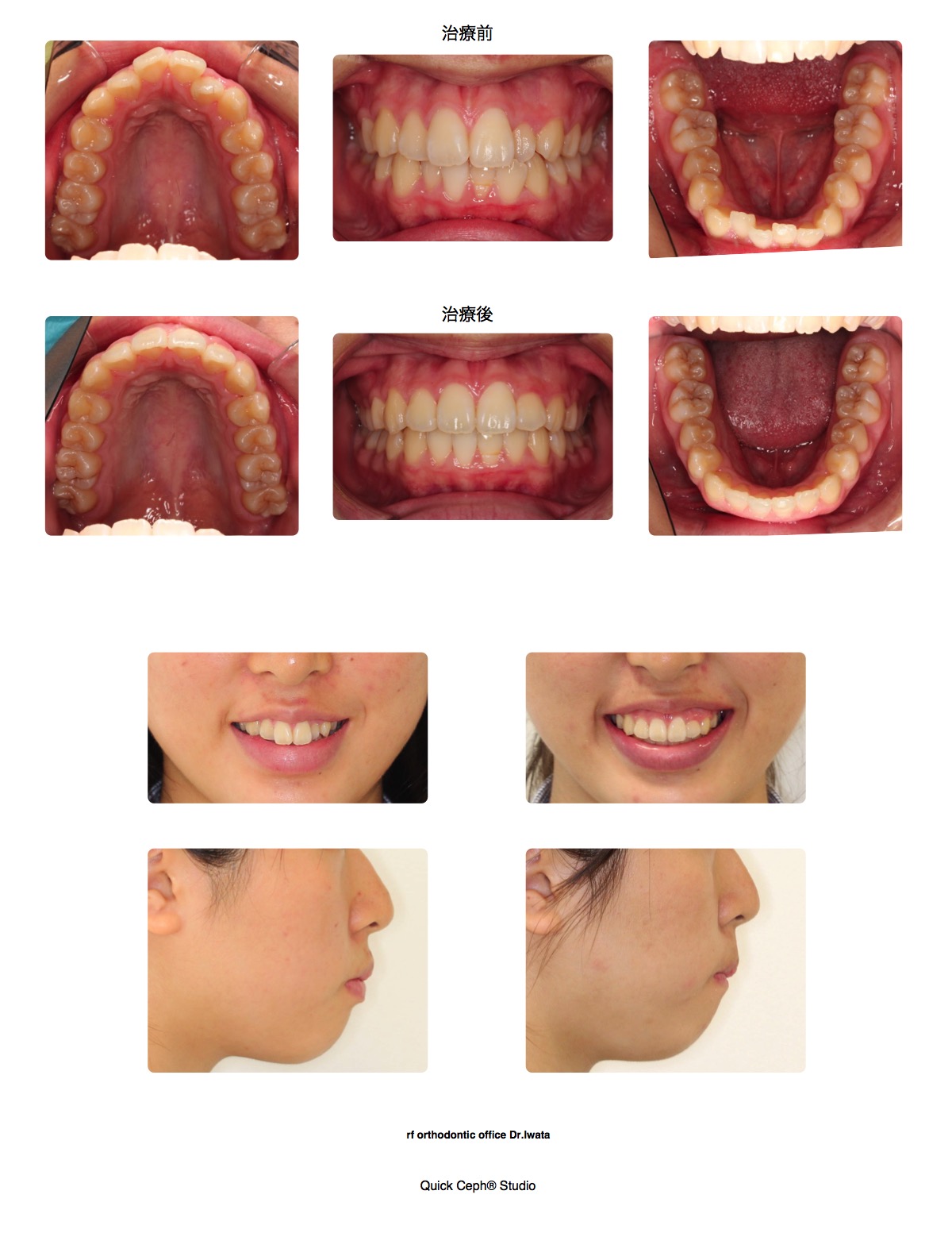 上下顎前突症例 <叢生を伴う狭窄歯列に対する非抜歯矯正治療>