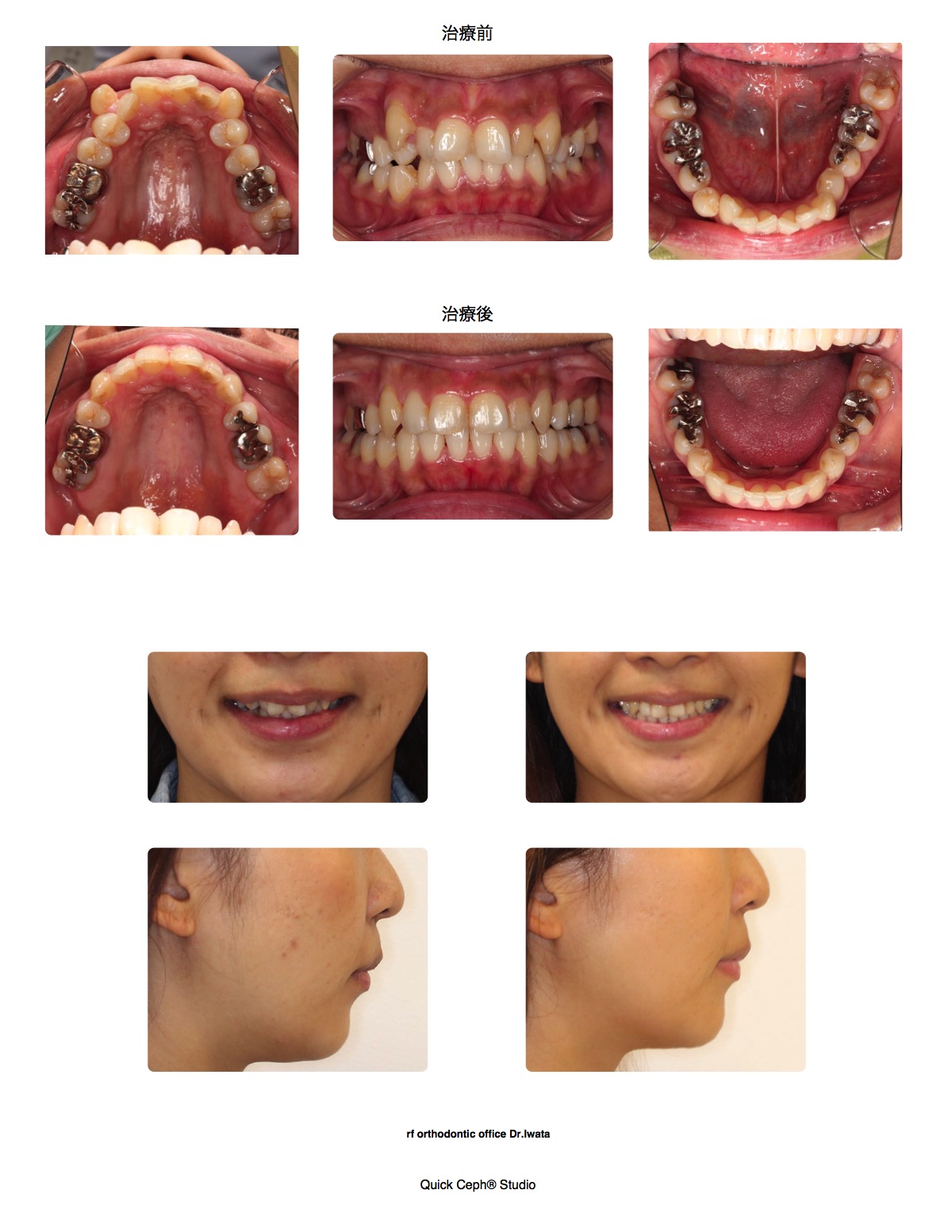 叢生症例　＜八重歯を伴う叢生に対する片顎抜歯矯正治療＞