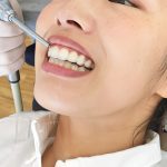 インビザライン チューウィーの大切さ