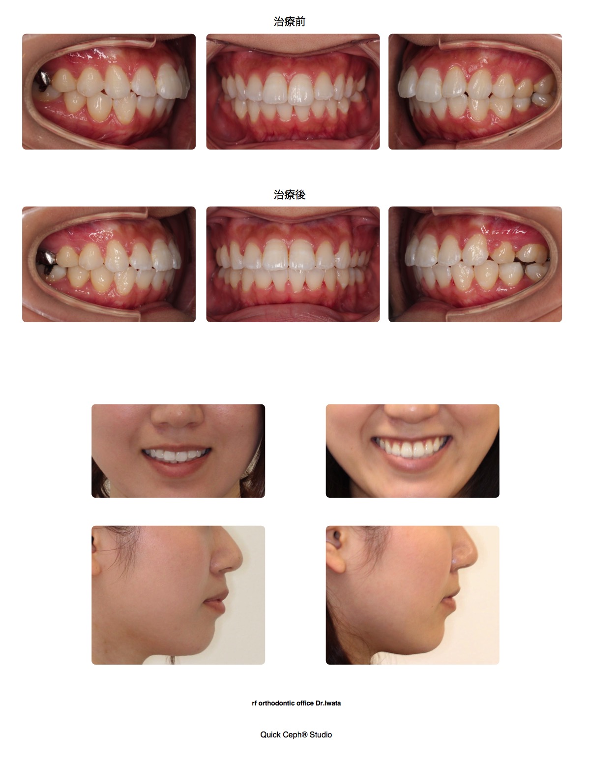 上顎前突症例 　＜左右非対称のため上顎第一小臼歯1本のみの抜歯矯正治療＞