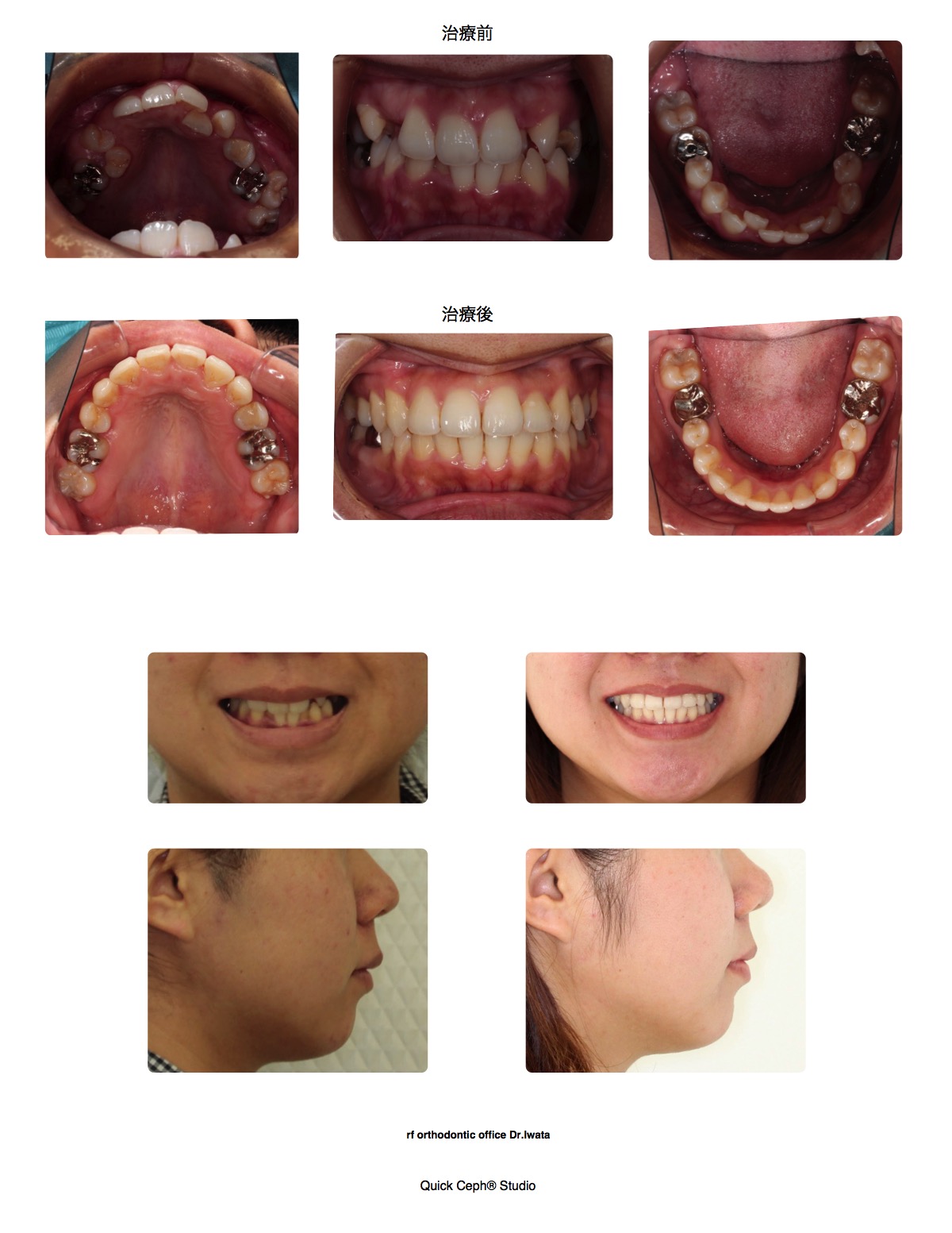 叢生症例　＜埋伏歯と先天欠如を伴う重度叢生症例に対する抜歯矯正治療＞