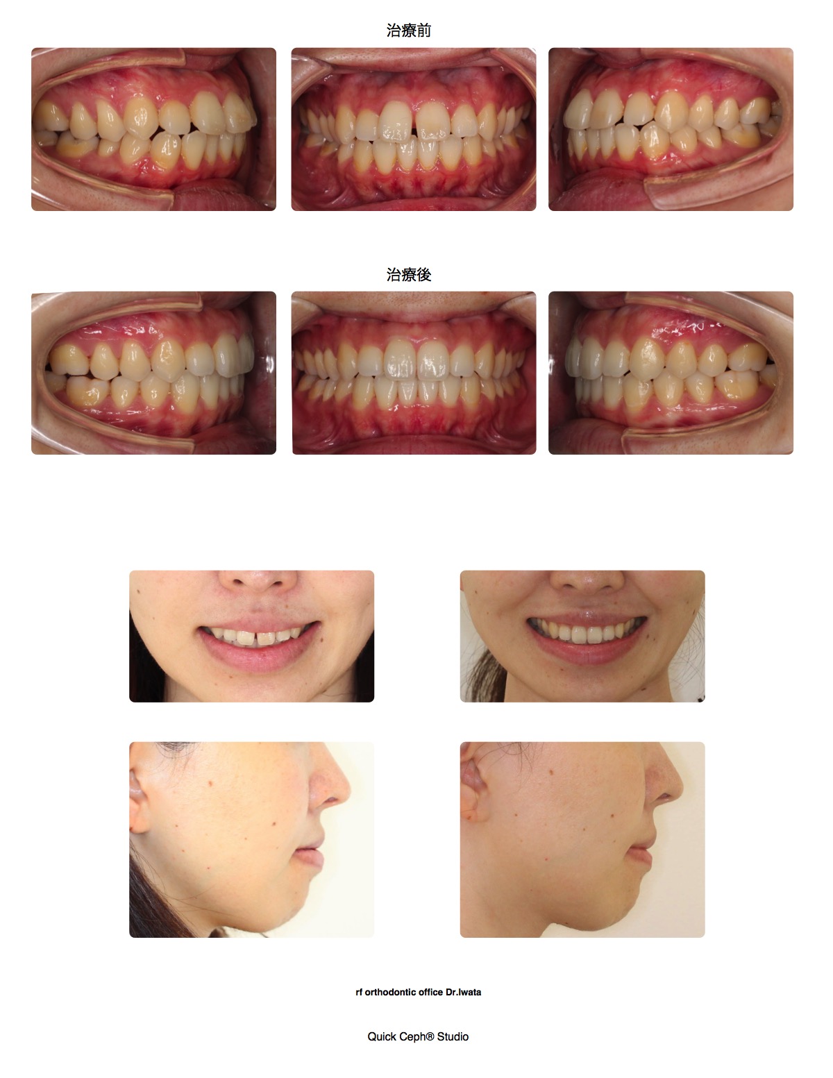 空隙歯列症例 <正中離開を伴う上下顎前突に対する非抜歯矯正治療>
