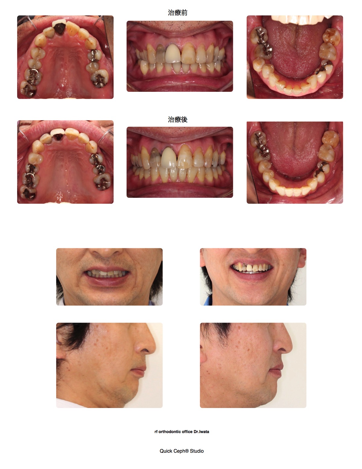 上顎前突症例 　＜インビザライン による拡大と遠心移動を併用した非抜歯矯正治療＞