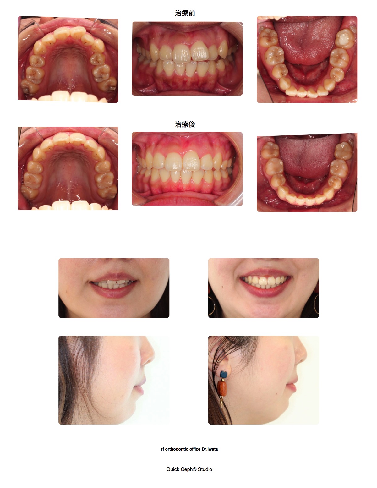 叢生症例　＜上下顎4本抜歯矯正後の後戻りによる叢生に対する非抜歯矯正治療＞