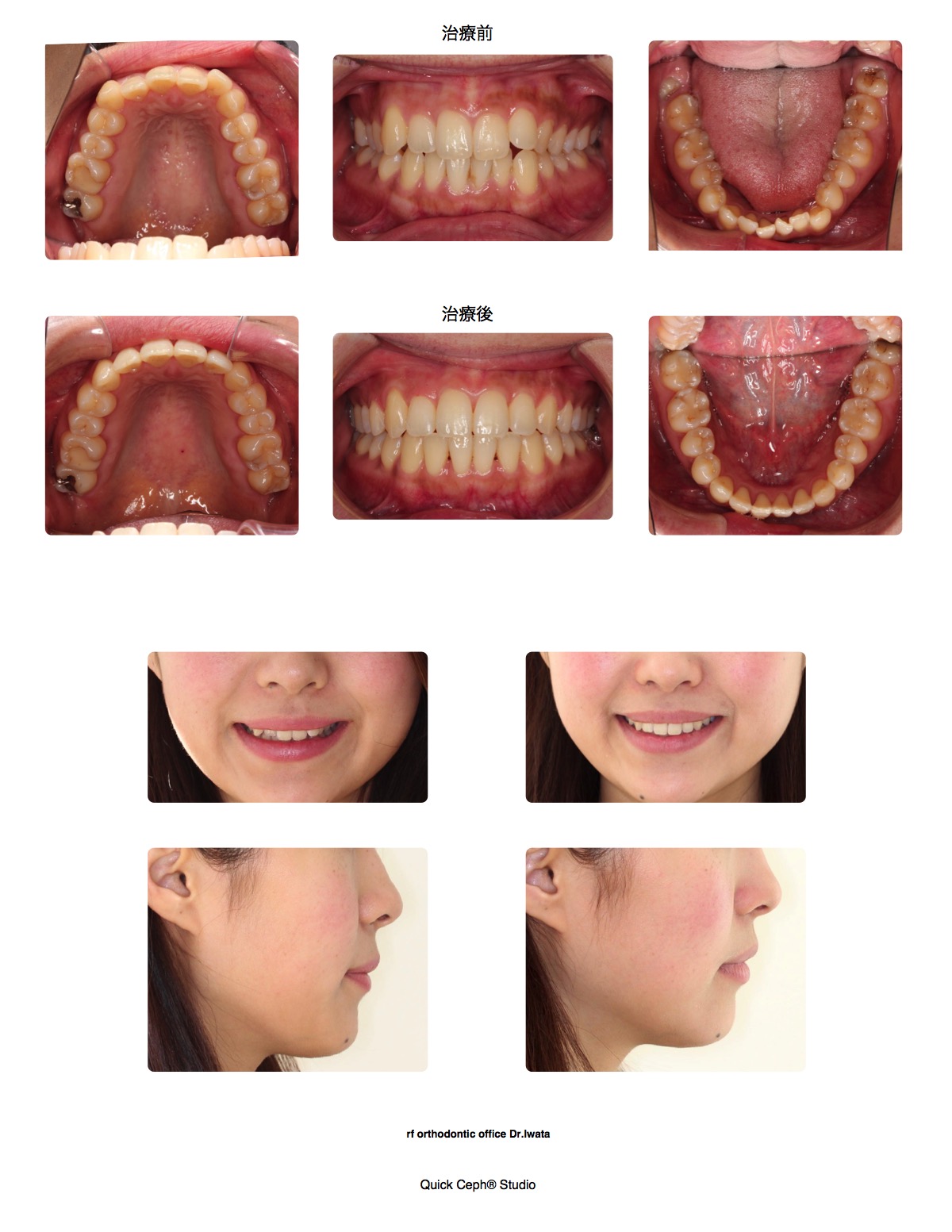 叢生症例　＜上下顎前歯部叢生に対する非抜歯矯正治療＞