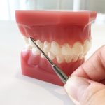 インビザライン イージーリフトの取り扱いについて