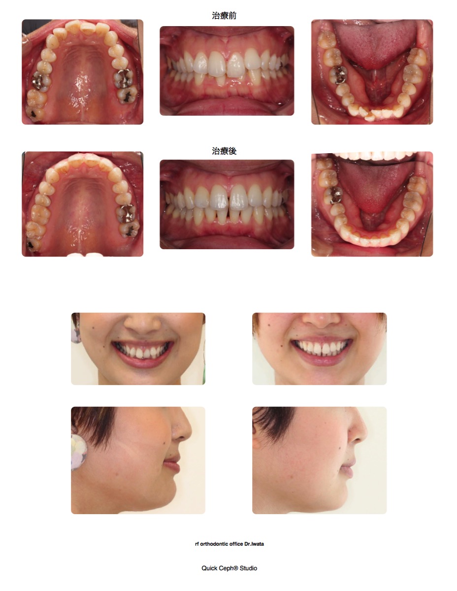 過盖咬合症例 <上下顎前歯部叢生を併う過蓋咬合に対する非抜歯矯正治療>