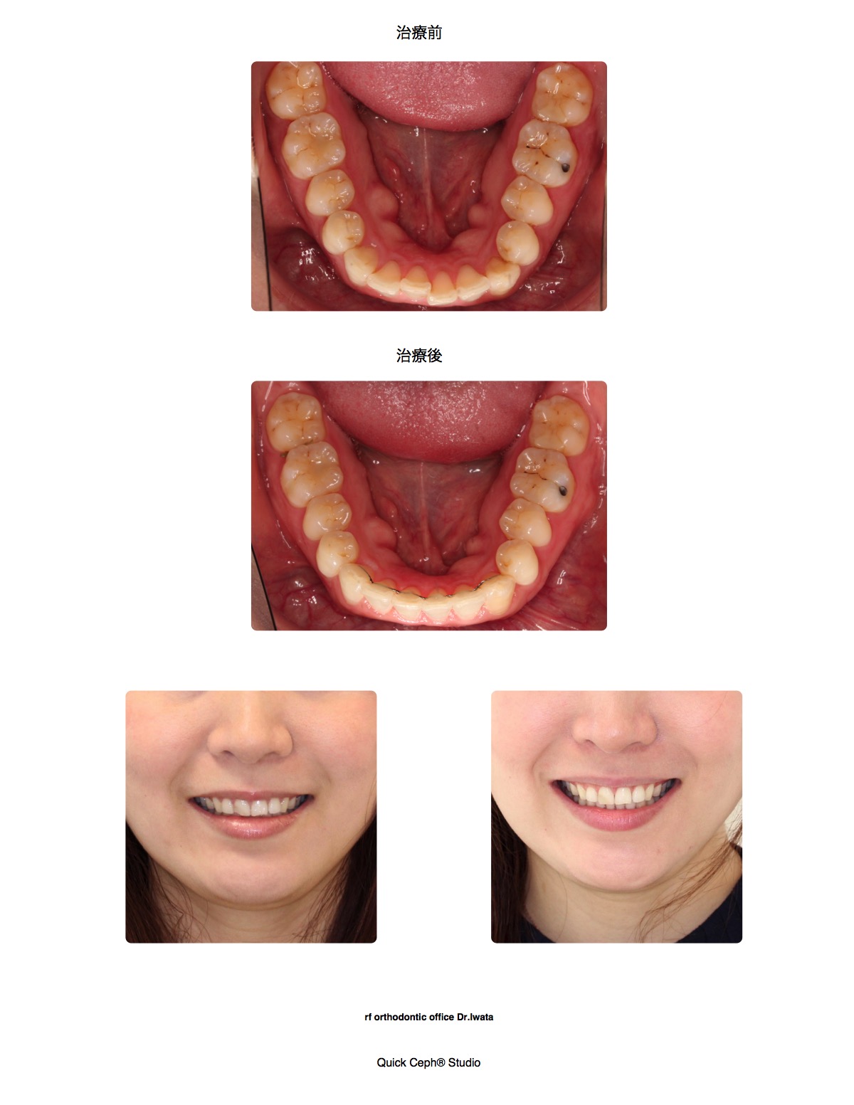叢生症例　＜下顎前歯部叢生に対する部分矯正治療＞