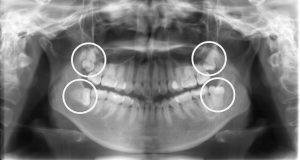 親知らずは抜かないと矯正治療はできないのですか？
