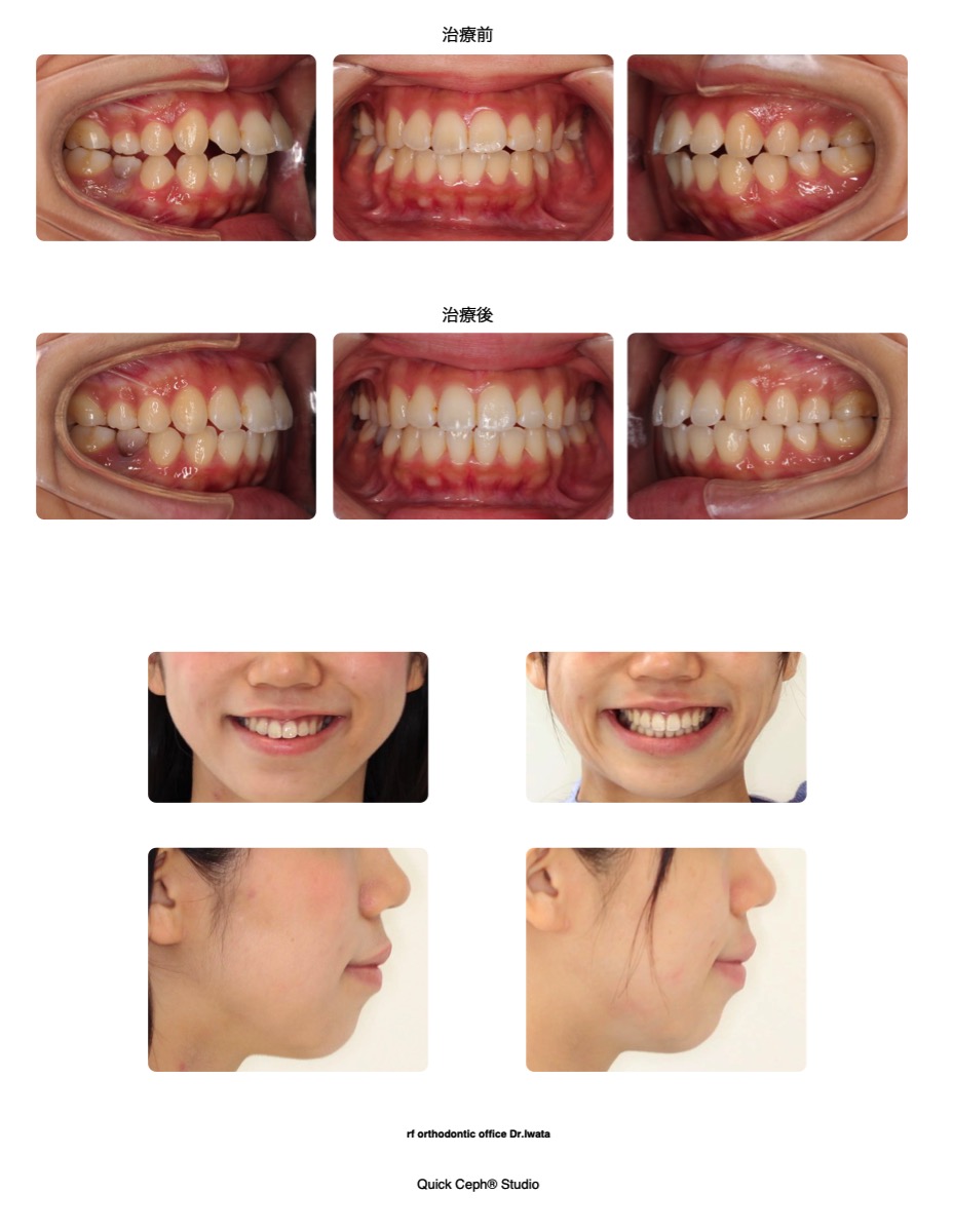 上顎前突症例 　＜上顎の後方移動を行った非抜歯矯正治療＞