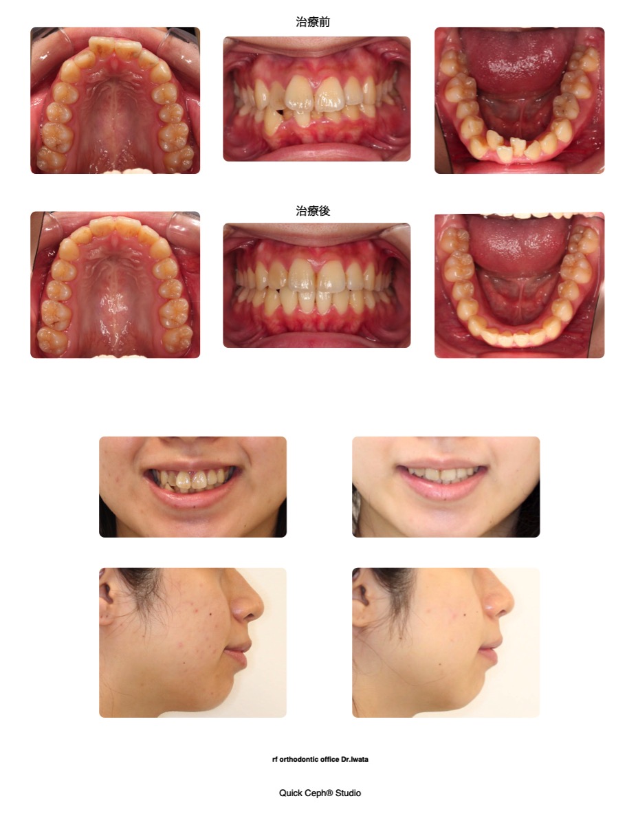 叢生症例　＜下顎乳臼歯晩期残存および第２小臼歯埋伏を伴う上下顎前歯部叢生に対する非抜歯矯正治療＞
