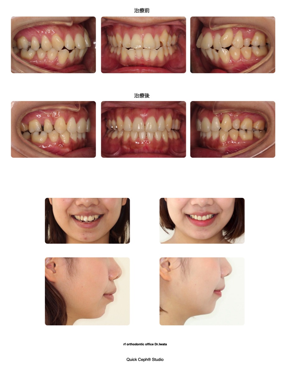 上下顎前突症例 <叢生と口元の前突を伴う上下顎前突に対する抜歯矯正治療>