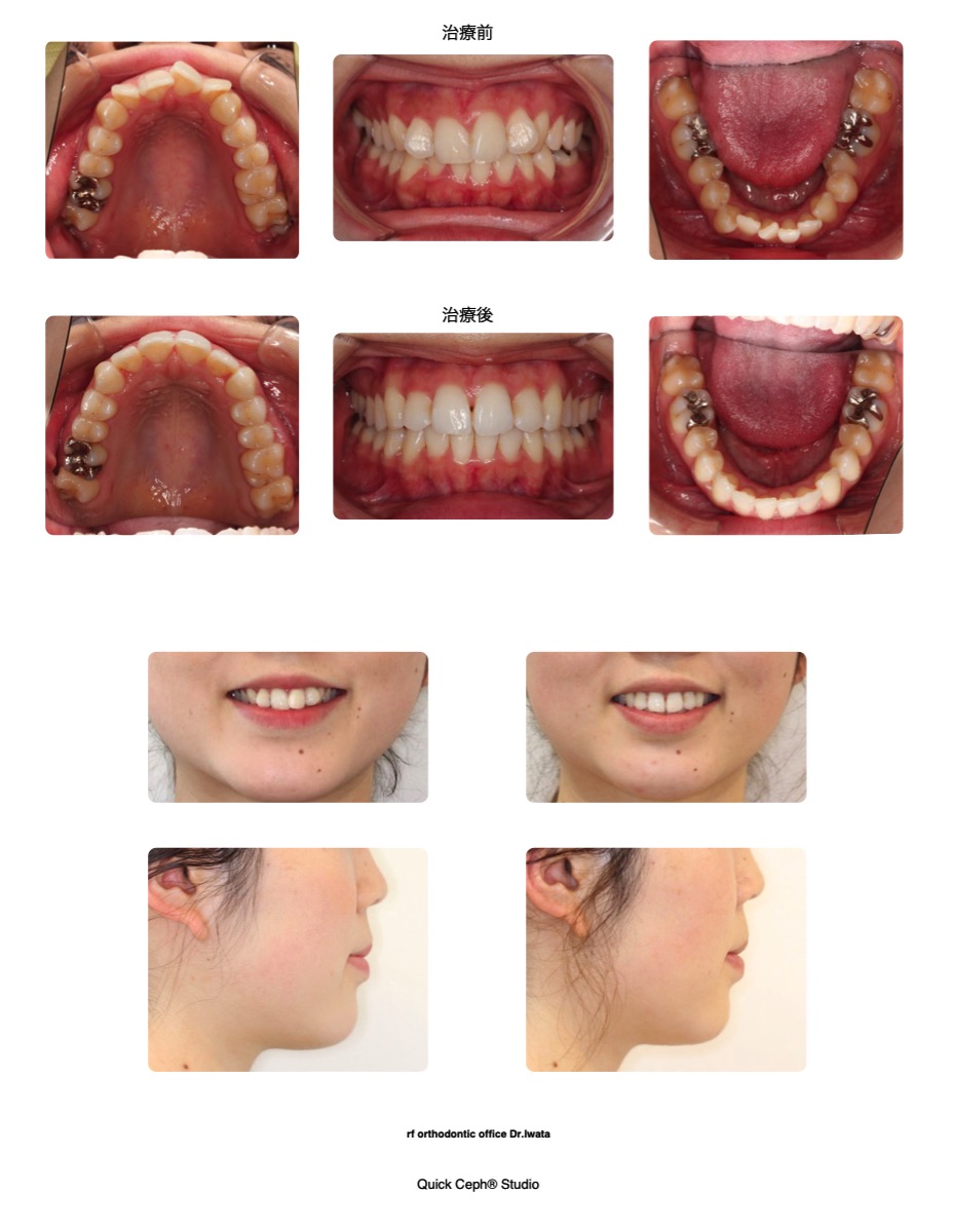叢生症例　＜過蓋咬合を伴う上下顎前歯部叢生に対する非抜歯矯正治療＞