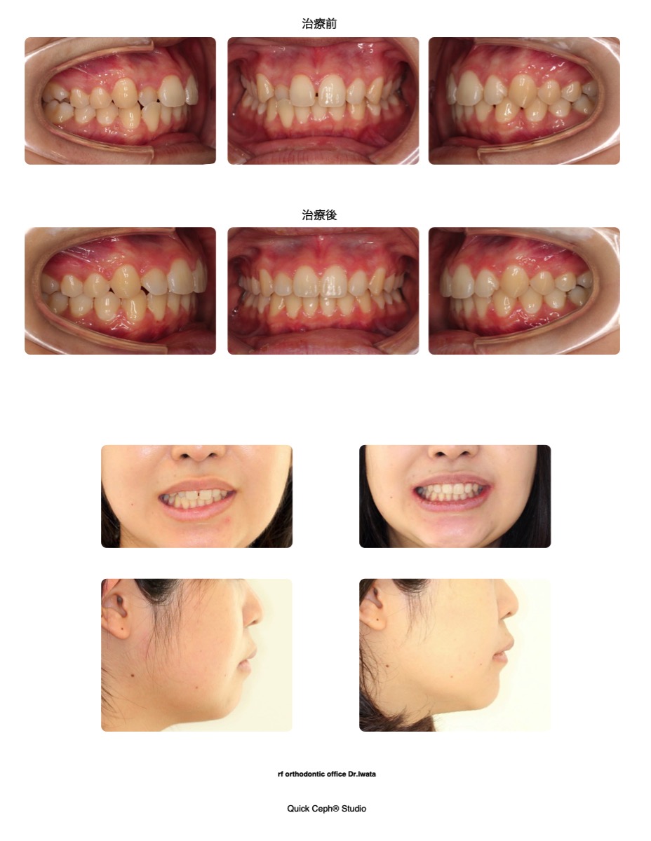 空隙歯列症例　＜正中離開と叢生を伴う空隙歯列に対する非抜歯矯正治療＞
