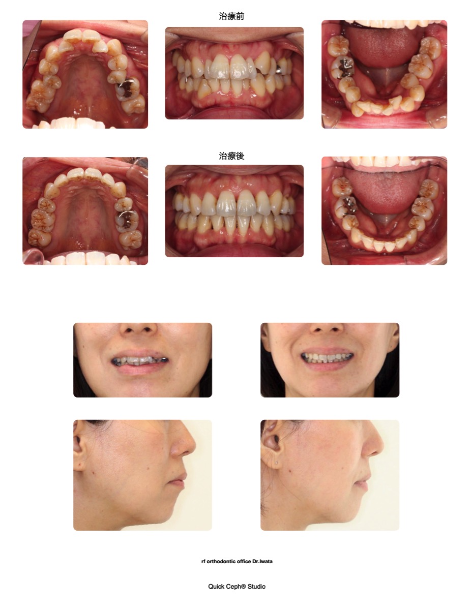 叢生症例　＜上下顎歯列の狭窄を伴う重度叢生に対する抜歯矯正治療＞