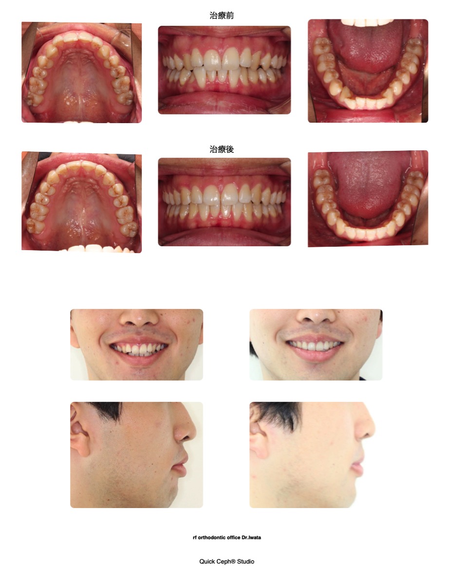叢生症例　＜正中のズレを伴う上下顎叢生に対する非抜歯矯正治療＞