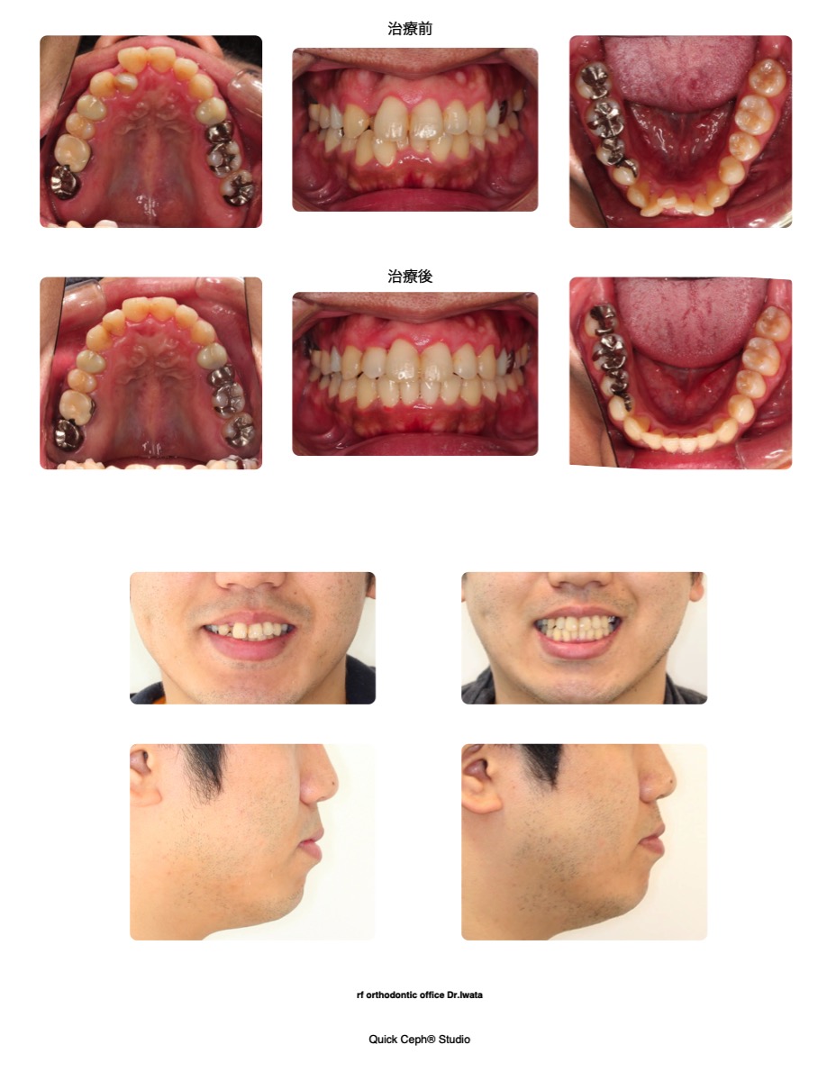 叢生症例　＜上下顎前歯部の重度叢生に対する非抜歯矯正治療＞