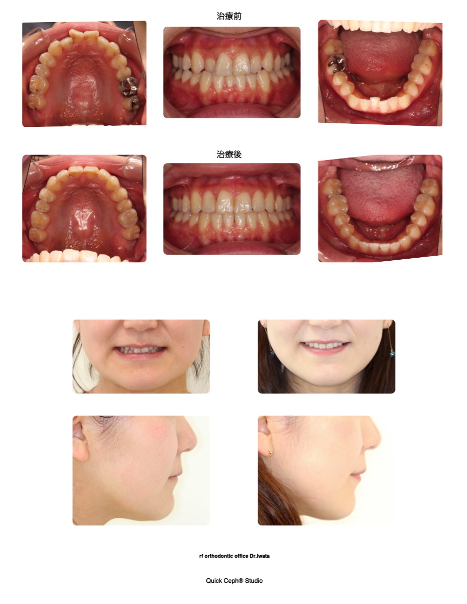 叢生症例　＜翼状捻転を伴う上下顎前歯部叢生に対する非抜歯矯正治療＞