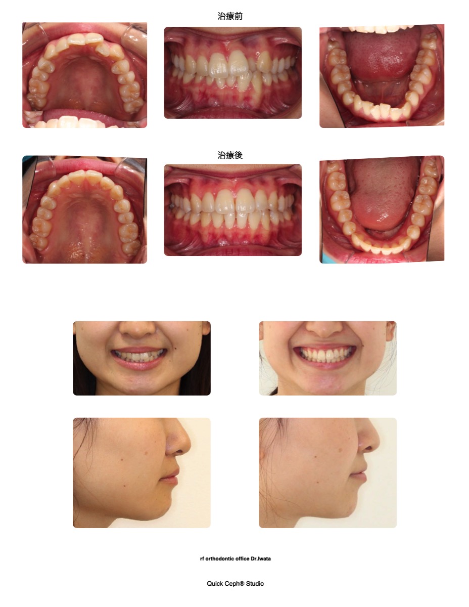 叢生症例　＜重度の上下顎前歯部叢生に対する非抜歯矯正治療＞