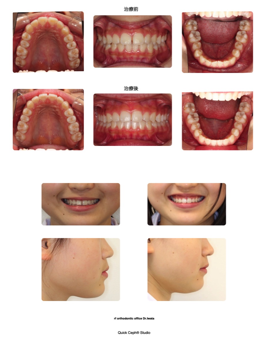 空隙歯列症例　＜正中離開と叢生を伴う空隙歯列に対する非抜歯矯正治療＞