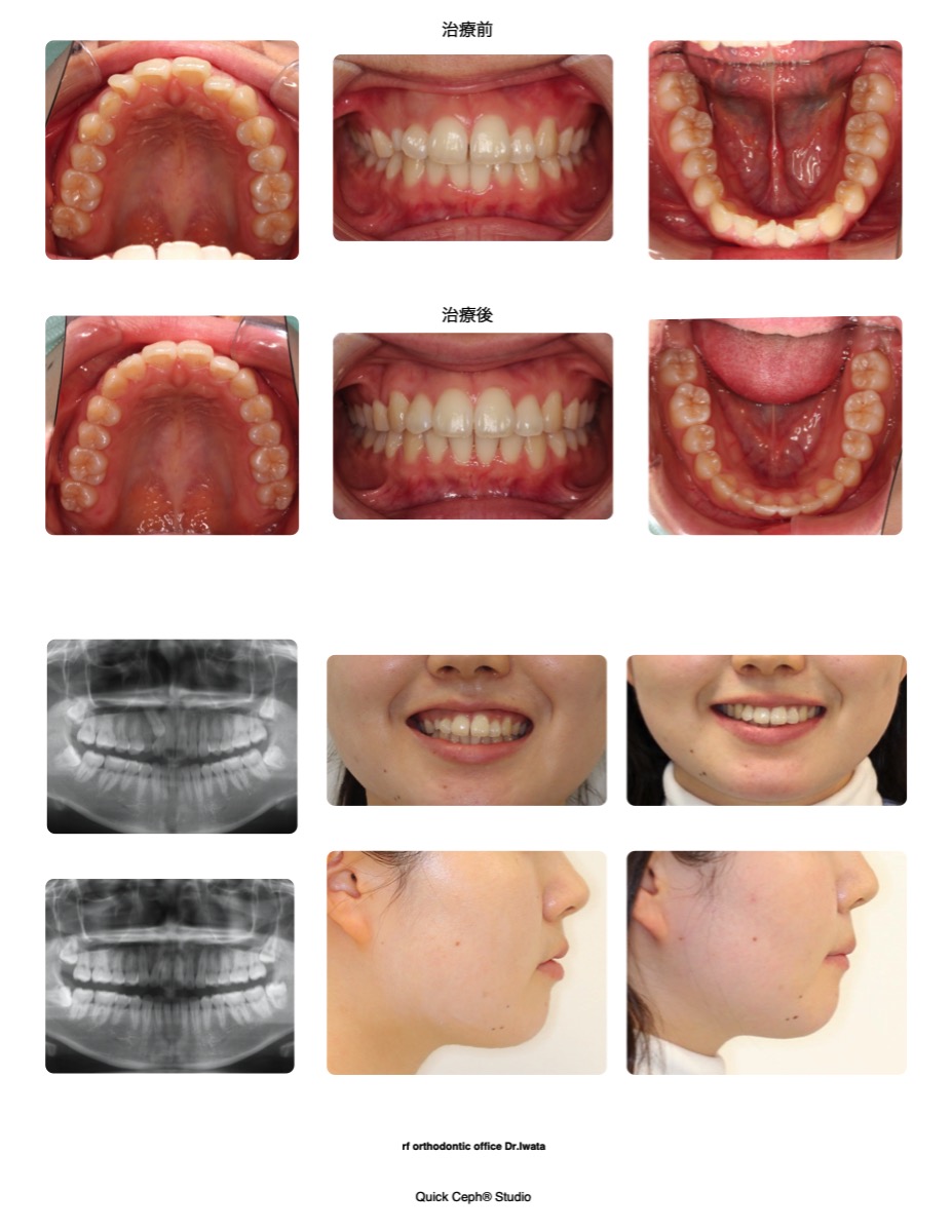 叢生症例　＜犬歯埋伏を伴う上下顎叢生に対して牽引を行った非抜歯矯正治療＞