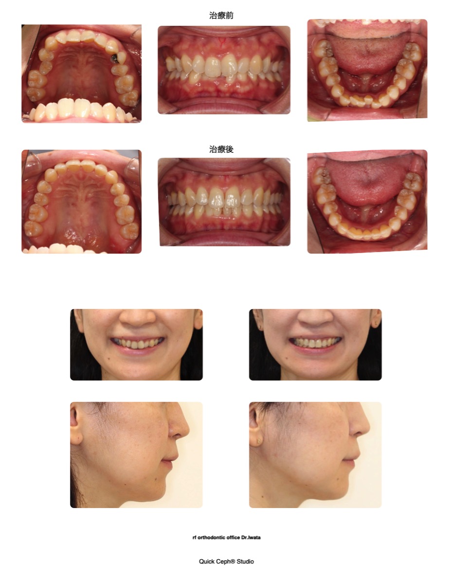 過盖咬合症例 <90°捻転を含む叢生および下顎前歯癒合歯を併う過蓋咬合に対する非抜歯矯正治療>