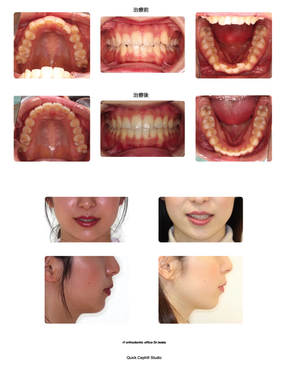 叢生症例　＜転勤の予定がある上下顎前歯部叢生の患者様に対する非抜歯矯正治療＞