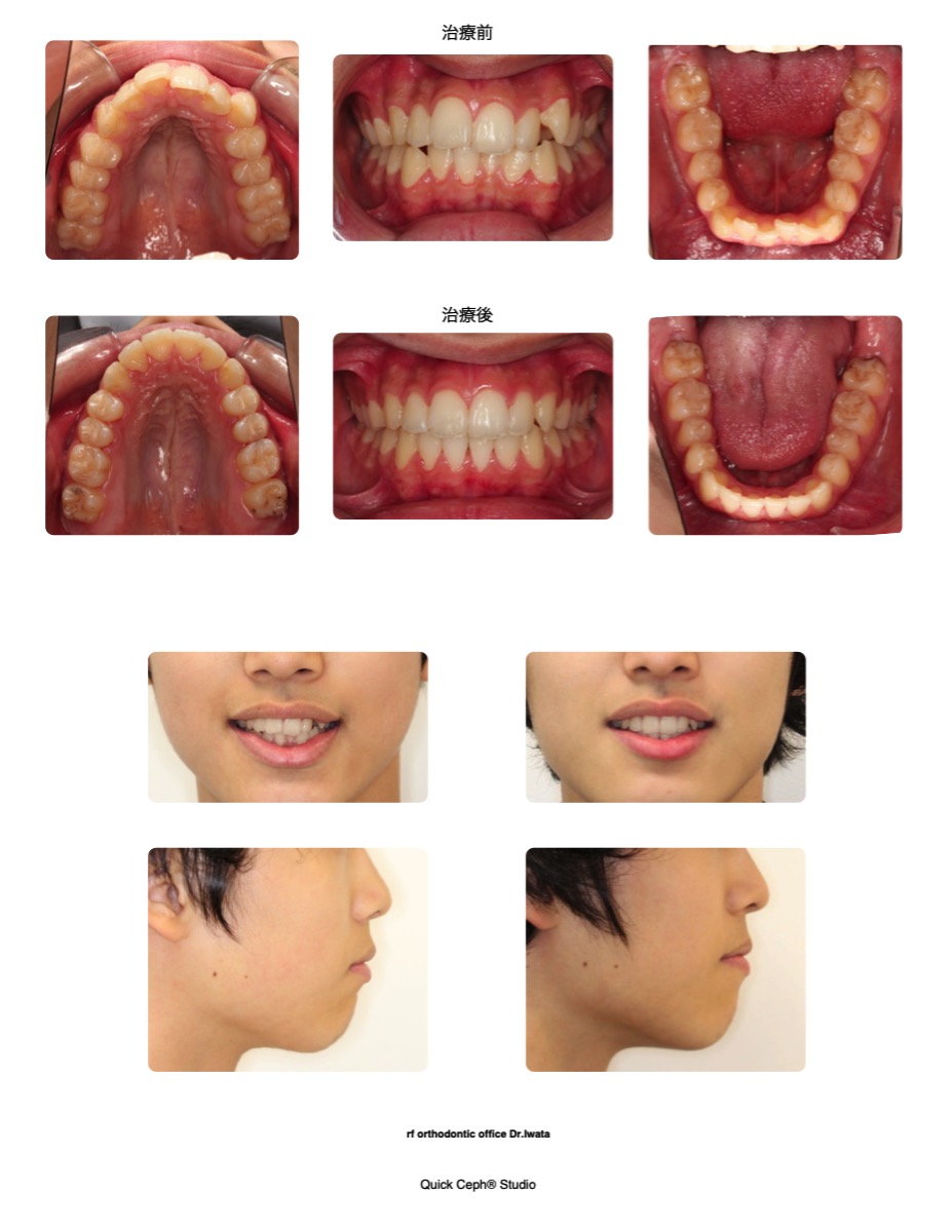 叢生症例　＜上下顎歯列狭窄を伴う前歯部叢生に対する非抜歯矯正治療＞