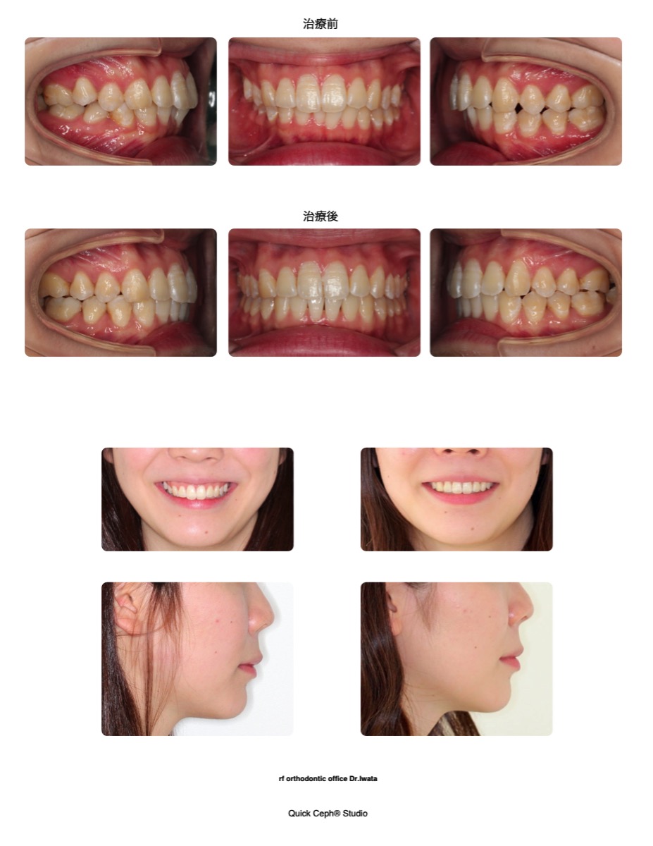 上顎前突症例 　＜正中のズレを改善するため片側のみ後方移動を行った非抜歯矯正治療＞
