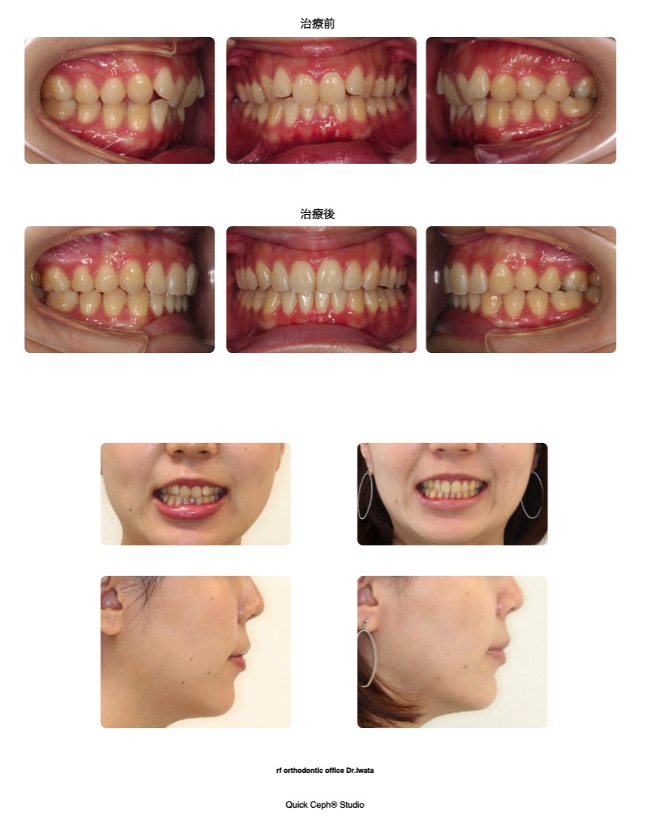 過盖咬合症例 <叢生を併う過蓋咬合に対する非抜歯矯正治療>