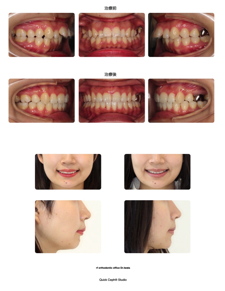 上顎前突症例 　＜上顎のみの抜歯により出っ歯を改善した抜歯矯正治療＞