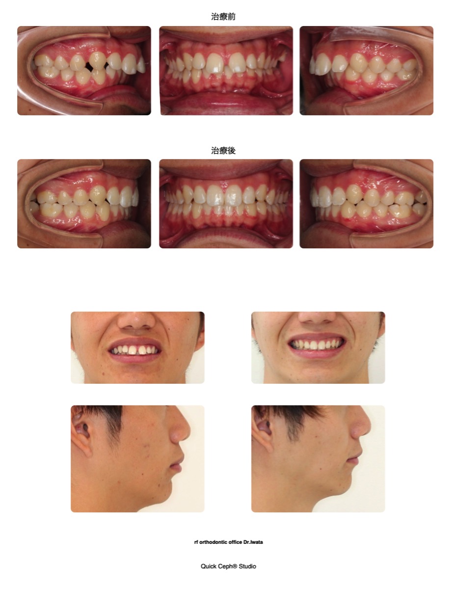 空隙歯列症例　＜正中離開と過蓋咬合を伴う空隙歯列に対する非抜歯矯正治療＞