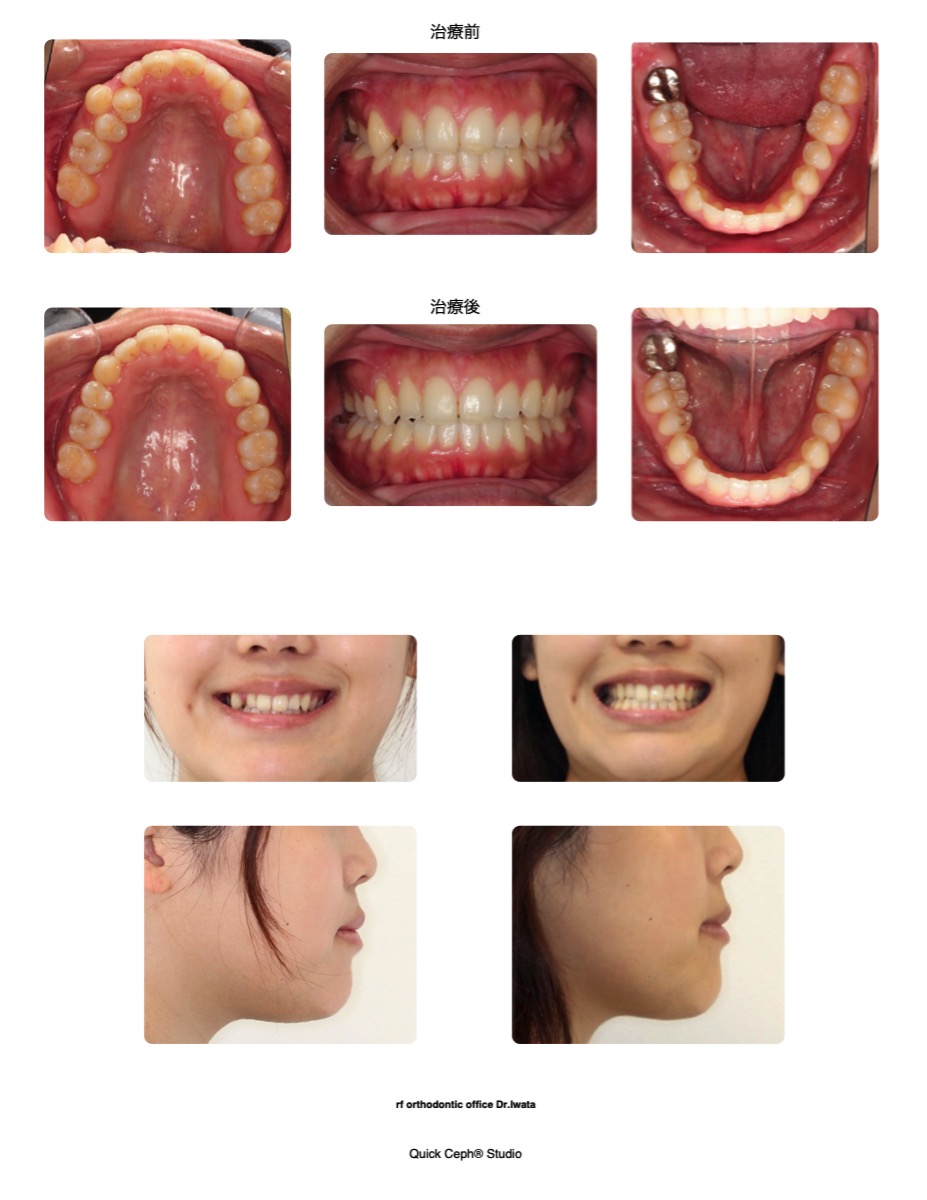 叢生症例　＜移転歯を伴う叢生に対する上顎右側１本抜歯矯正治療＞