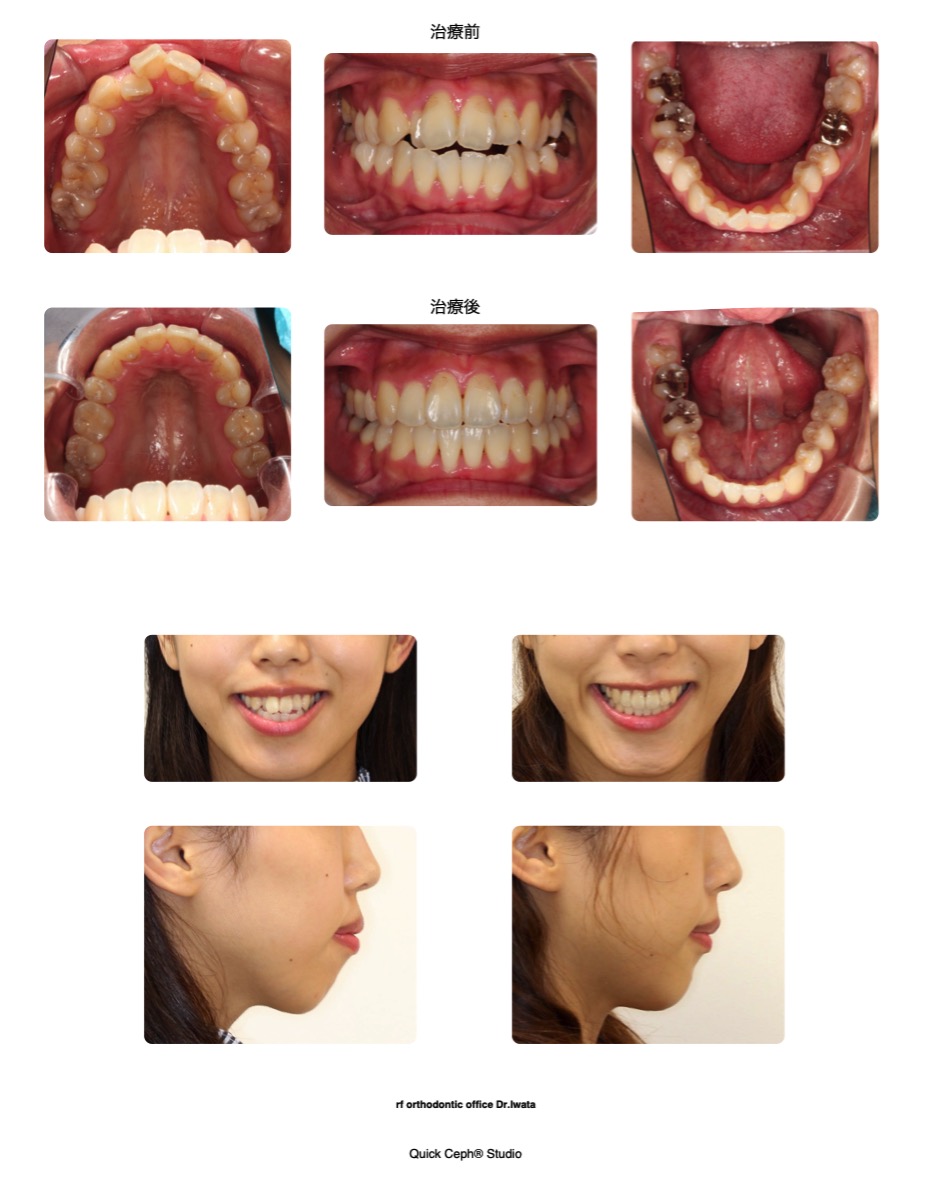 上下顎前突症例 <小臼歯抜歯と保存不可の下顎大臼歯抜歯により口元の前突を改善した抜歯矯正治療>
