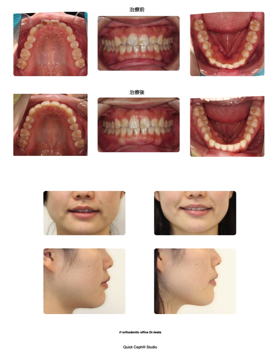 叢生症例　＜上下正中のズレを伴う上下顎前歯叢生に対する非抜歯矯正治療＞