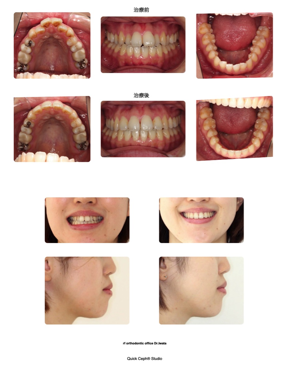 叢生症例　＜上下顎歯列狭窄を伴う上下顎前歯叢生に対する非抜歯矯正治療＞