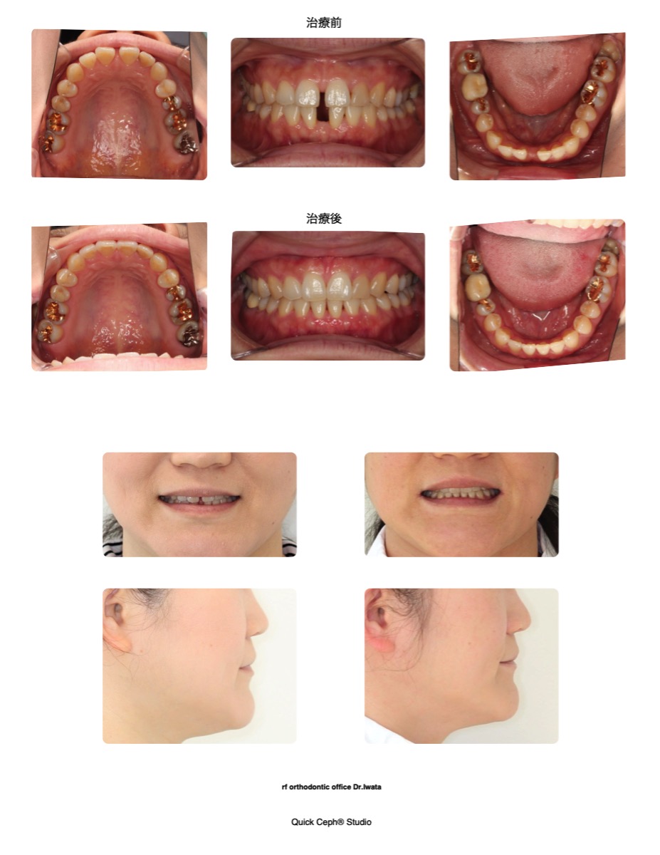 空隙歯列症例　＜上下の重度正中離開を伴う空隙歯列に対する非抜歯矯正治療＞