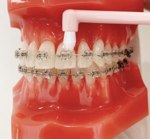 ワイヤー矯正のブラッシング