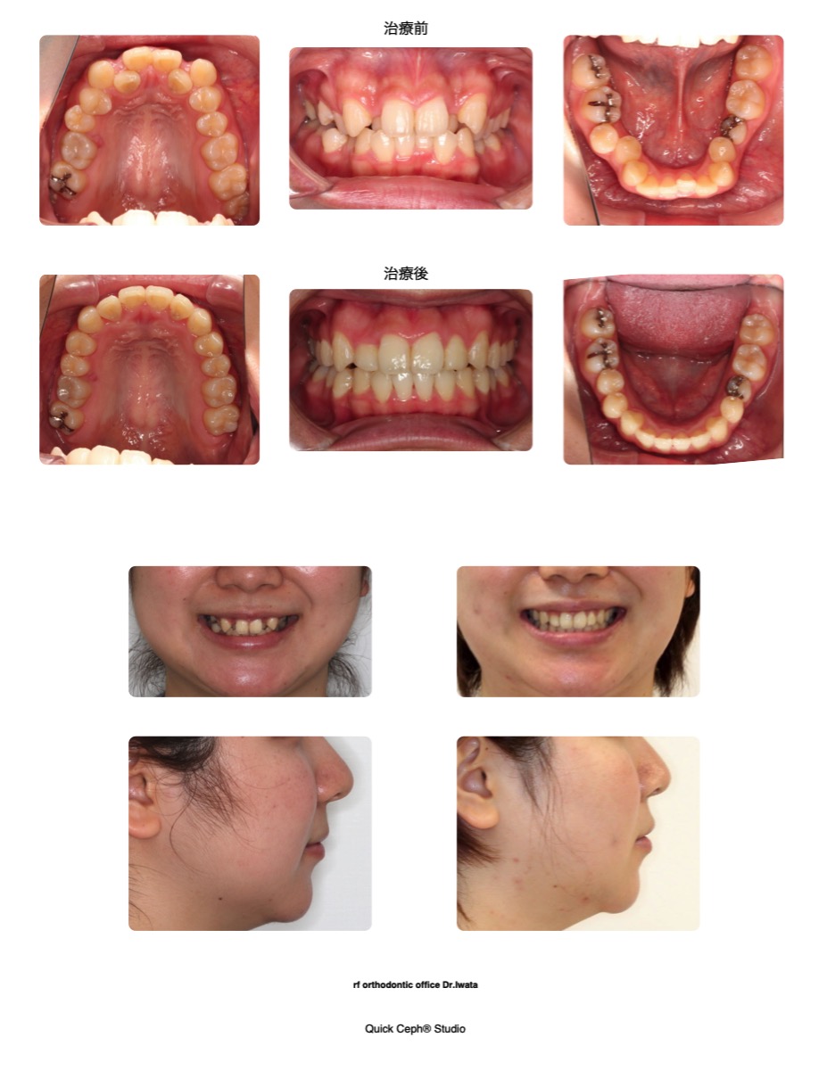 叢生症例　＜八重歯を伴う上下顎重度の叢生に対する非抜歯矯正治療＞