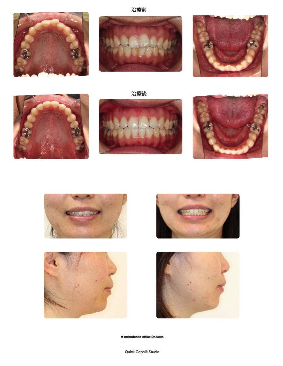叢生症例　＜正中のズレを伴う上下顎前歯部叢生に対する非抜歯矯正治療＞