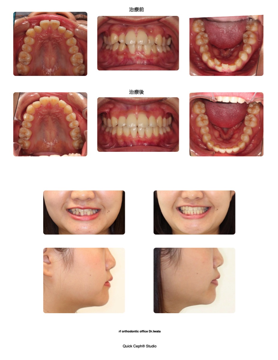 叢生症例　＜上下顎前歯部の重度叢生に対する非抜歯矯正治療＞