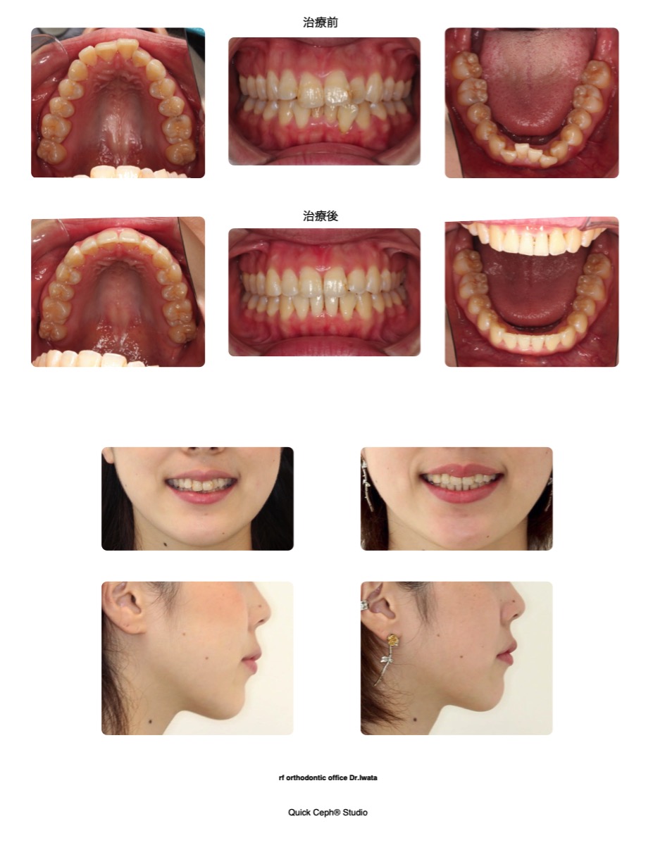 叢生症例　＜歯列狭窄を伴う上下顎前歯部叢生に対する非抜歯矯正治療＞