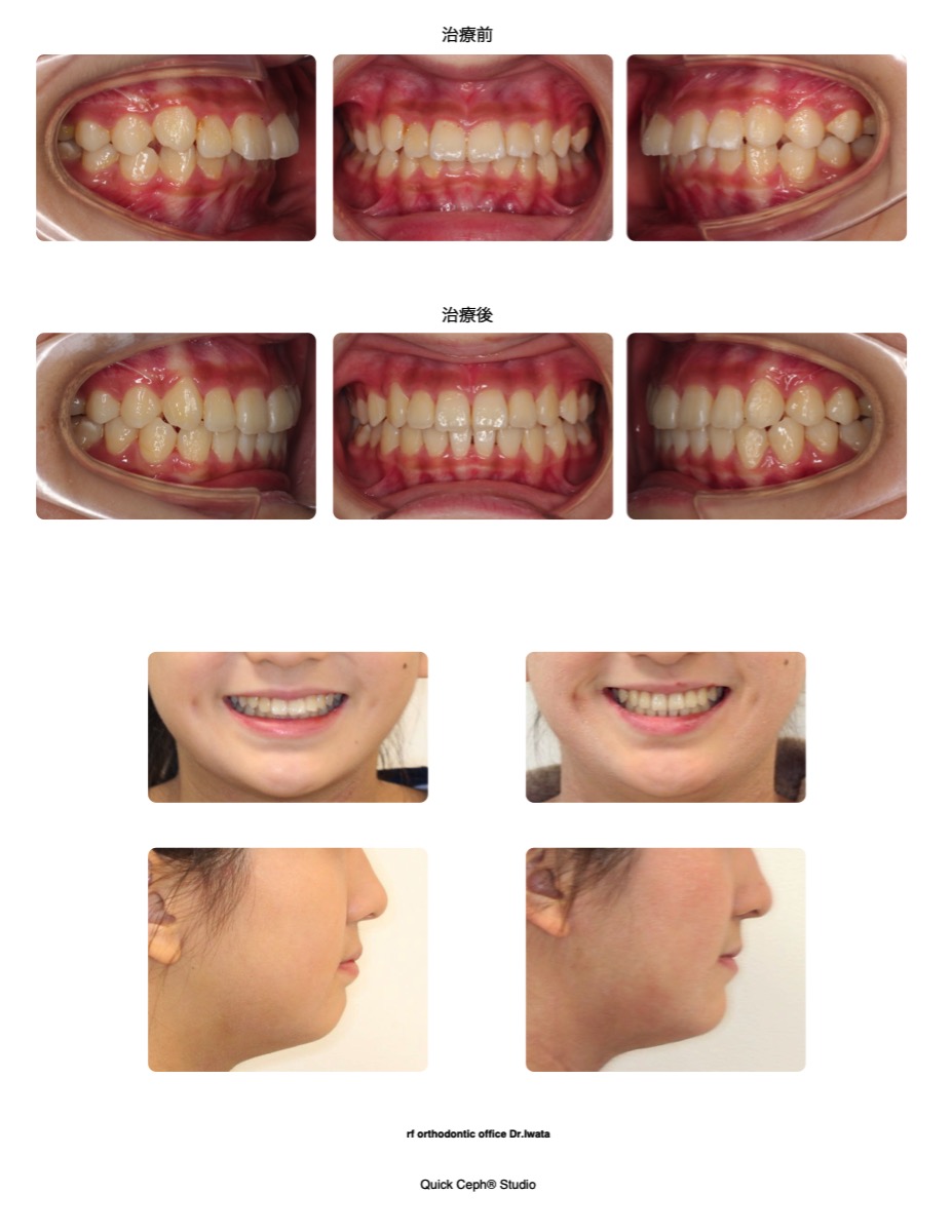 上顎前突症例 <過蓋咬合を伴う前歯の前突を改善した非抜歯矯正治療>