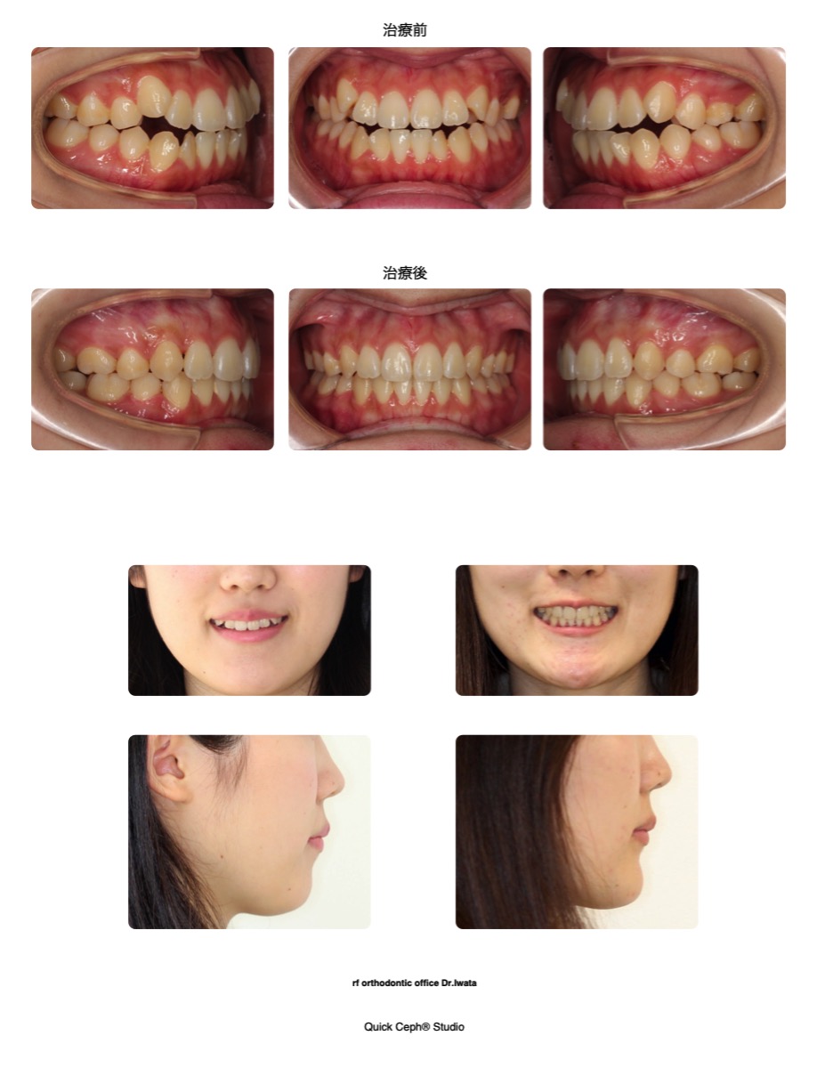 開咬症例 <叢生を併う開咬(オープンバイト)に対する抜歯矯正治療>