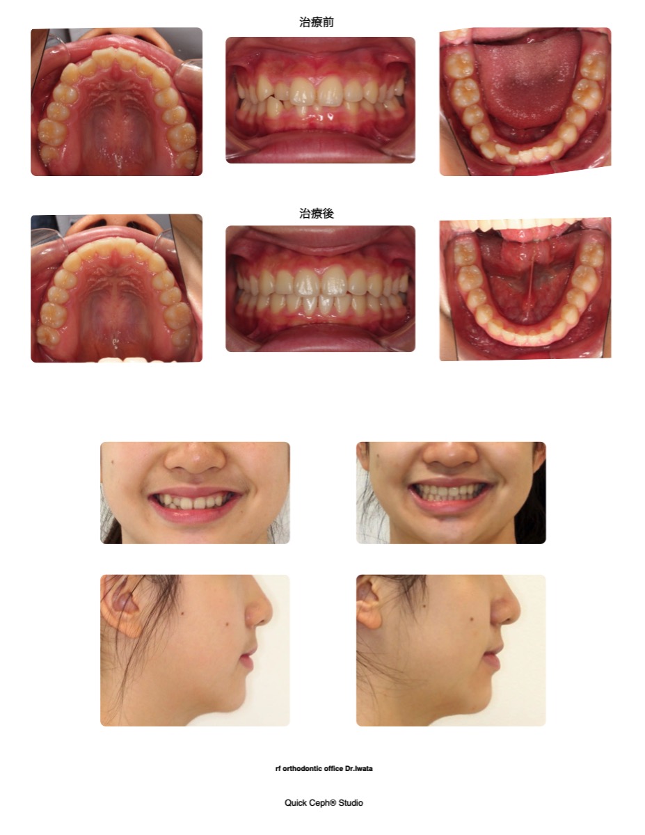 叢生症例　＜上下顎前歯部叢生に対する非抜歯矯正治療＞