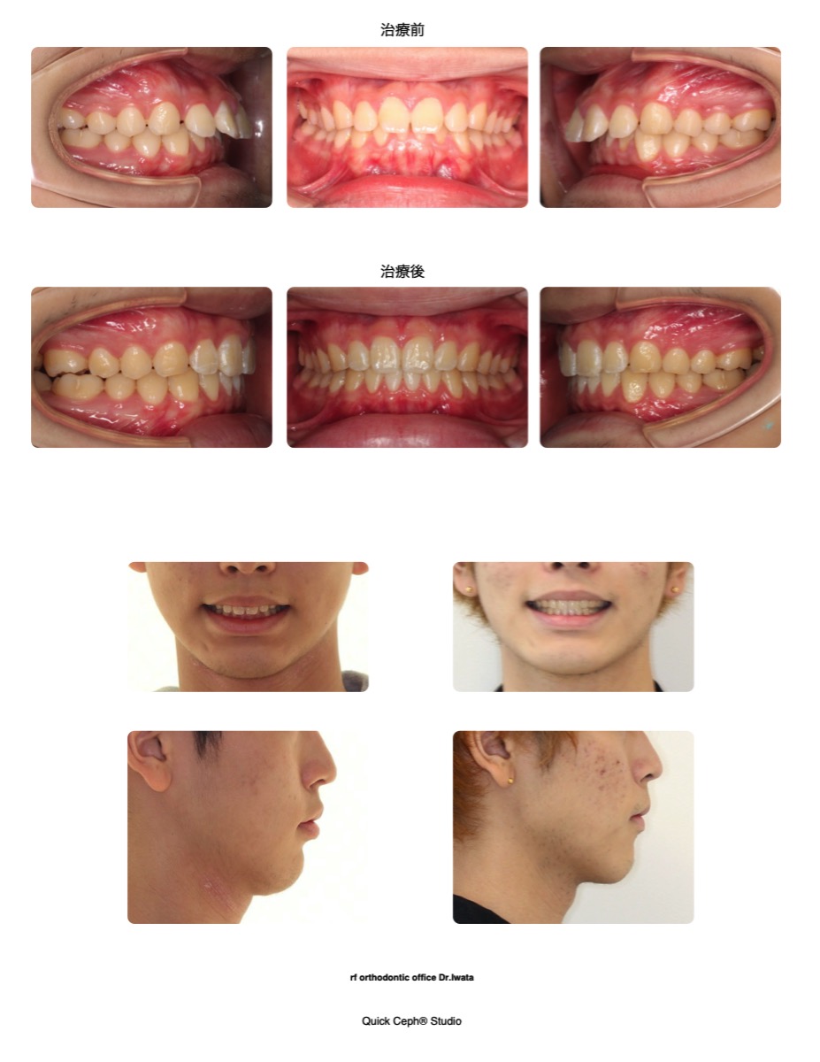 過盖咬合症例 <前歯の前突を併う過蓋咬合に対する非抜歯矯正治療>