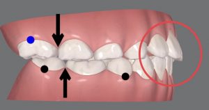 マウスピースに羽⁉︎