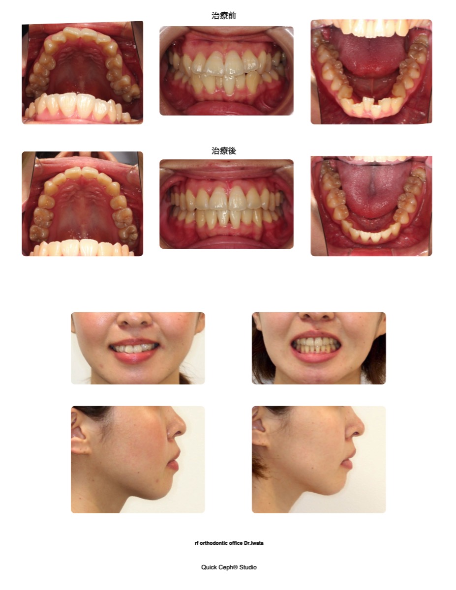 上下顎前突症例 　＜上顎は後方、下顎は前方の小臼歯抜歯により叢生と口元の前突を改善した抜歯矯正治療＞