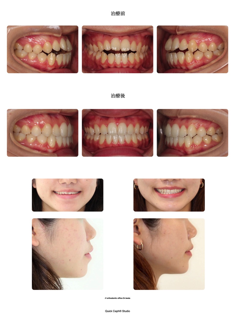 開咬症例 <軽度叢生を伴う開咬に対する非抜歯矯正治療>