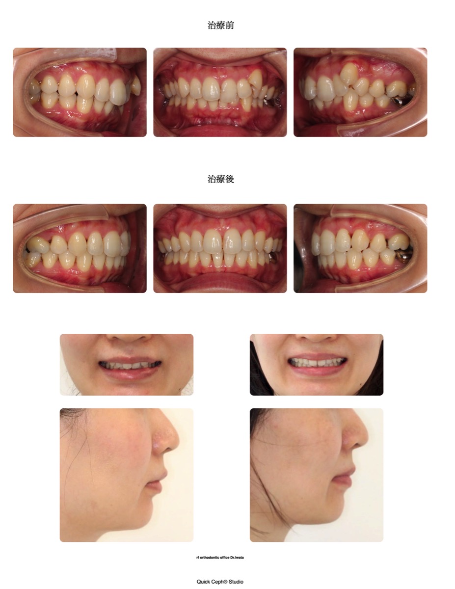 過盖咬合症例　＜上下顎叢生を併う過蓋咬合に対する抜歯矯正治療＞